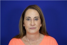 Rhinoplasty After Photo by Thanapoom Boonipat, MD; Lubbock, TX - Case 50857