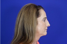 Rhinoplasty After Photo by Thanapoom Boonipat, MD; Lubbock, TX - Case 50857
