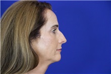 Rhinoplasty Before Photo by Thanapoom Boonipat, MD; Lubbock, TX - Case 50857