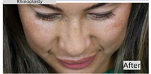 Rhinoplasty After Photo by Thanapoom Boonipat, MD; Lubbock, TX - Case 50866
