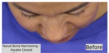 Rhinoplasty Before Photo by Thanapoom Boonipat, MD; Lubbock, TX - Case 50866