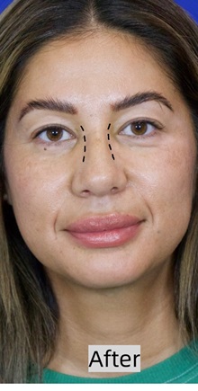 Rhinoplasty After Photo by Thanapoom Boonipat, MD; Lubbock, TX - Case 50866