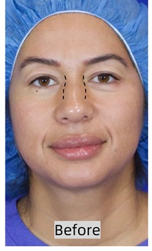 Rhinoplasty Before Photo by Thanapoom Boonipat, MD; Lubbock, TX - Case 50866