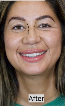 Rhinoplasty After Photo by Thanapoom Boonipat, MD; Lubbock, TX - Case 50866