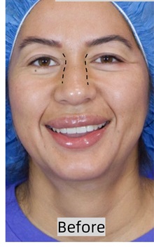 Rhinoplasty Before Photo by Thanapoom Boonipat, MD; Lubbock, TX - Case 50866