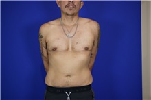 Chest Masculinization Surgery After Photo by Thanapoom Boonipat, MD; Lubbock, TX - Case 50876