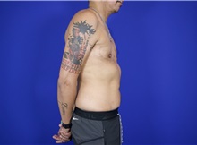 Chest Masculinization Surgery After Photo by Thanapoom Boonipat, MD; Lubbock, TX - Case 50876