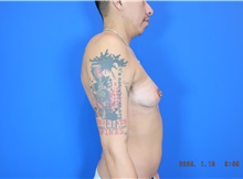 Chest Masculinization Surgery Before Photo by Thanapoom Boonipat, MD; Lubbock, TX - Case 50876
