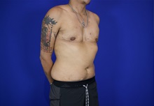 Chest Masculinization Surgery After Photo by Thanapoom Boonipat, MD; Lubbock, TX - Case 50876
