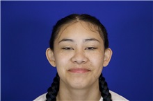 Ear Surgery Before Photo by Thanapoom Boonipat, MD; Lubbock, TX - Case 50900