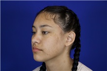 Ear Surgery Before Photo by Thanapoom Boonipat, MD; Lubbock, TX - Case 50900