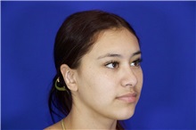 Ear Surgery After Photo by Thanapoom Boonipat, MD; Lubbock, TX - Case 50900