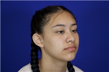 Ear Surgery Before Photo by Thanapoom Boonipat, MD; Lubbock, TX - Case 50900