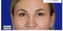 Eyelid Surgery After Photo by Thanapoom Boonipat, MD; Lubbock, TX - Case 50902