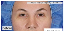 Eyelid Surgery Before Photo by Thanapoom Boonipat, MD; Lubbock, TX - Case 50902