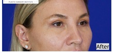 Eyelid Surgery After Photo by Thanapoom Boonipat, MD; Lubbock, TX - Case 50902