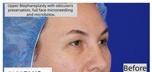 Eyelid Surgery Before Photo by Thanapoom Boonipat, MD; Lubbock, TX - Case 50902