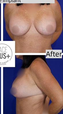 Breast Augmentation After Photo by Thanapoom Boonipat, MD; Lubbock, TX - Case 50905