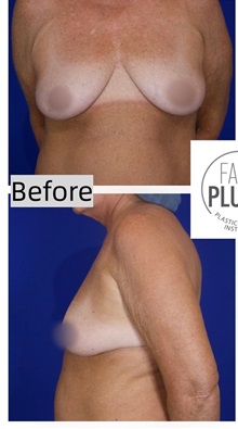 Breast Augmentation Before Photo by Thanapoom Boonipat, MD; Lubbock, TX - Case 50905