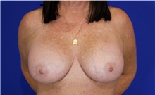 Breast Augmentation After Photo by Thanapoom Boonipat, MD; Lubbock, TX - Case 50905