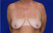 Breast Augmentation Before Photo by Thanapoom Boonipat, MD; Lubbock, TX - Case 50905