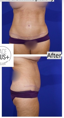 Tummy Tuck After Photo by Thanapoom Boonipat, MD; Lubbock, TX - Case 50906