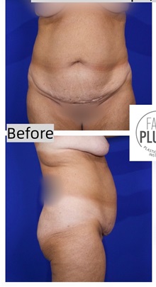 Tummy Tuck Before Photo by Thanapoom Boonipat, MD; Lubbock, TX - Case 50906