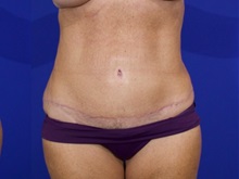 Tummy Tuck After Photo by Thanapoom Boonipat, MD; Lubbock, TX - Case 50906