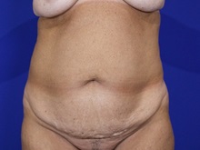 Tummy Tuck Before Photo by Thanapoom Boonipat, MD; Lubbock, TX - Case 50906