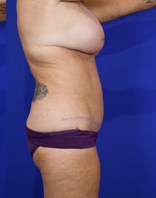 Tummy Tuck After Photo by Thanapoom Boonipat, MD; Lubbock, TX - Case 50906