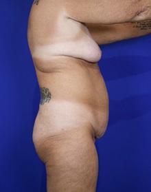Tummy Tuck Before Photo by Thanapoom Boonipat, MD; Lubbock, TX - Case 50906