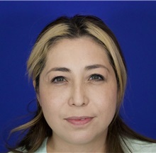 Eyelid Surgery After Photo by Thanapoom Boonipat, MD; Lubbock, TX - Case 51031