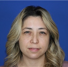 Eyelid Surgery Before Photo by Thanapoom Boonipat, MD; Lubbock, TX - Case 51031