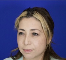 Eyelid Surgery After Photo by Thanapoom Boonipat, MD; Lubbock, TX - Case 51031