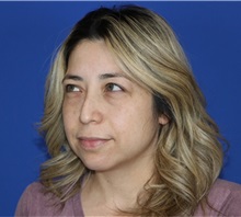 Eyelid Surgery Before Photo by Thanapoom Boonipat, MD; Lubbock, TX - Case 51031