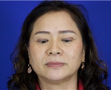 Eyelid Surgery After Photo by Thanapoom Boonipat, MD; Lubbock, TX - Case 51031