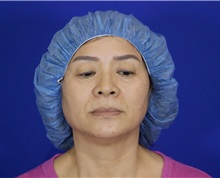 Eyelid Surgery Before Photo by Thanapoom Boonipat, MD; Lubbock, TX - Case 51031