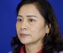Eyelid Surgery After Photo by Thanapoom Boonipat, MD; Lubbock, TX - Case 51031