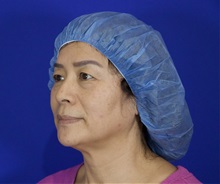 Eyelid Surgery Before Photo by Thanapoom Boonipat, MD; Lubbock, TX - Case 51031