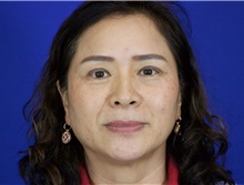 Eyelid Surgery After Photo by Thanapoom Boonipat, MD; Lubbock, TX - Case 51033