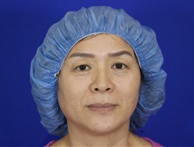 Eyelid Surgery Before Photo by Thanapoom Boonipat, MD; Lubbock, TX - Case 51033