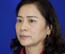 Eyelid Surgery After Photo by Thanapoom Boonipat, MD; Lubbock, TX - Case 51033