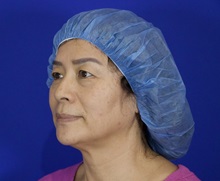 Eyelid Surgery Before Photo by Thanapoom Boonipat, MD; Lubbock, TX - Case 51033