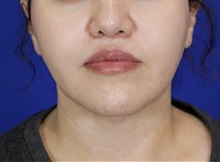 Liposuction After Photo by Thanapoom Boonipat, MD; Lubbock, TX - Case 51035