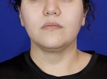 Liposuction Before Photo by Thanapoom Boonipat, MD; Lubbock, TX - Case 51035