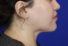 Liposuction After Photo by Thanapoom Boonipat, MD; Lubbock, TX - Case 51035
