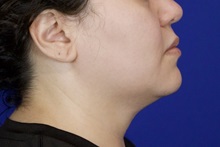 Liposuction Before Photo by Thanapoom Boonipat, MD; Lubbock, TX - Case 51035