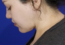 Liposuction After Photo by Thanapoom Boonipat, MD; Lubbock, TX - Case 51035