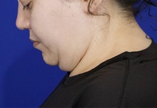 Liposuction Before Photo by Thanapoom Boonipat, MD; Lubbock, TX - Case 51035