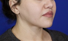 Liposuction After Photo by Thanapoom Boonipat, MD; Lubbock, TX - Case 51035